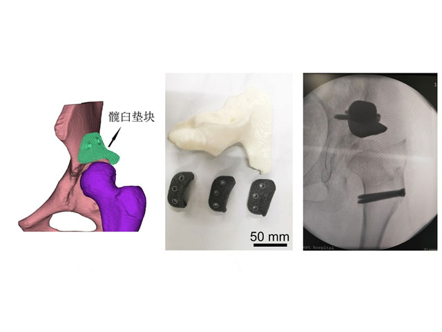 钽垫块辅助髋外科脱位入路下髋臼造盖术（与西南医院合作）